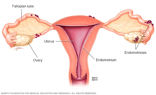 Endometriosis